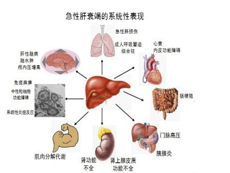 甚至会出现某些致死的并发症,如果食道静脉曲张破裂出血,并引发肝衰竭